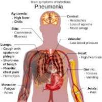 ภาวะติดเชื้อที่ปอดในผู้สูงอายุ-pneumonia