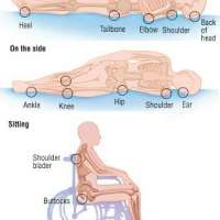 การป้องกันการเกิดแผลกดทับและวิธีดูแลผู้ป่วยที่มีแผลกดทับ
