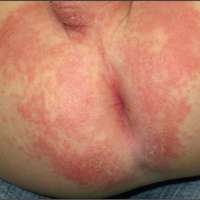 การผื่นผ้าอ้อมในผู้สูงอายุ-napply-rash