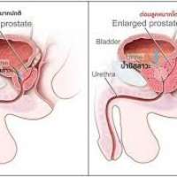 โรคต่อมลูกหมากโตในผู้สูงอายุ