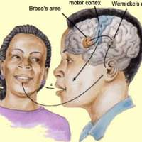 ความผิดปกติทางการพูดและทางภาษาในผู้ป่วยโรคหลอดเลือดสมอง-aphasia